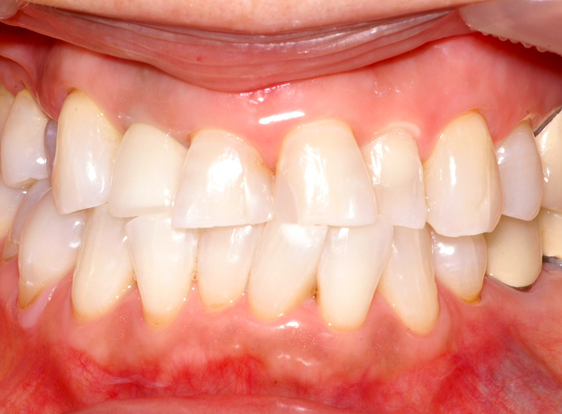 ホワイトニングアフター