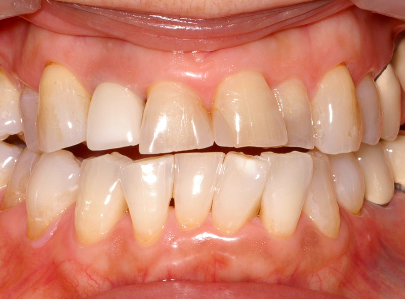 ホワイトニングビフォー